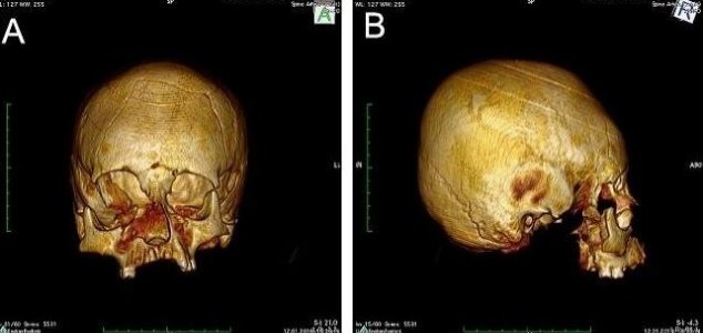 Misshapen skulls found in Croatia News-deformed-skull-2